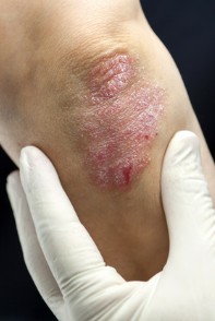 Le psoriasis est une maladie de la peau courante qui se manifeste par des plaques
