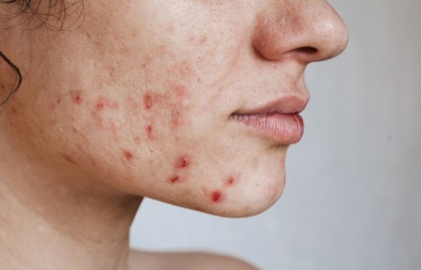L'acné est une maladie de peau fréquente chez les jeunes